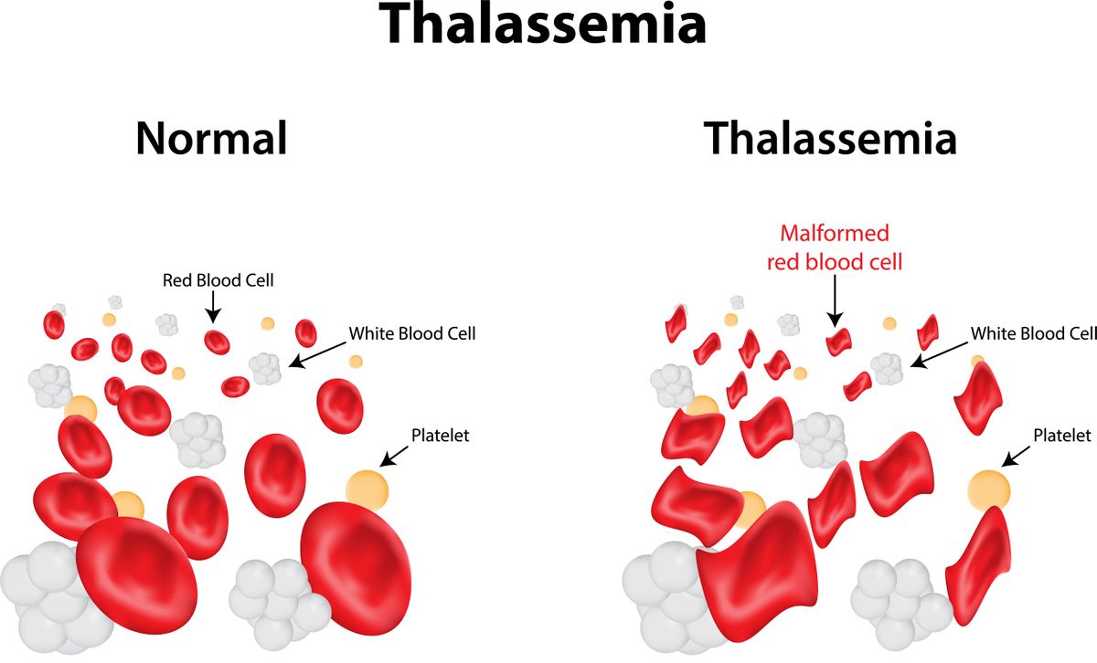 Thalassemia in Pregnancy